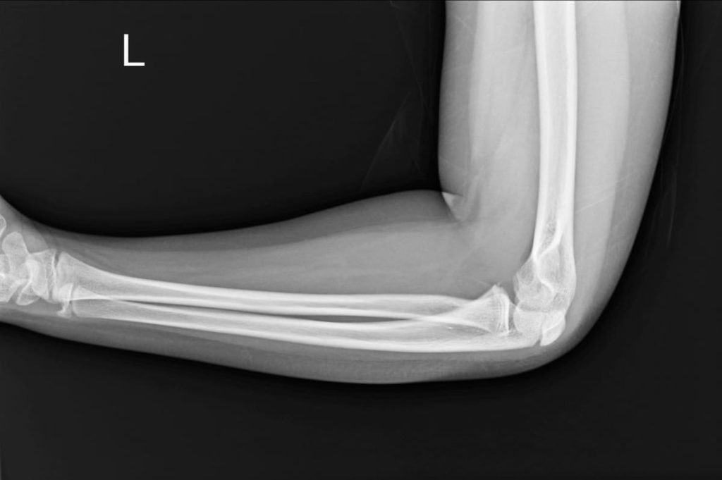 radiographie du coude